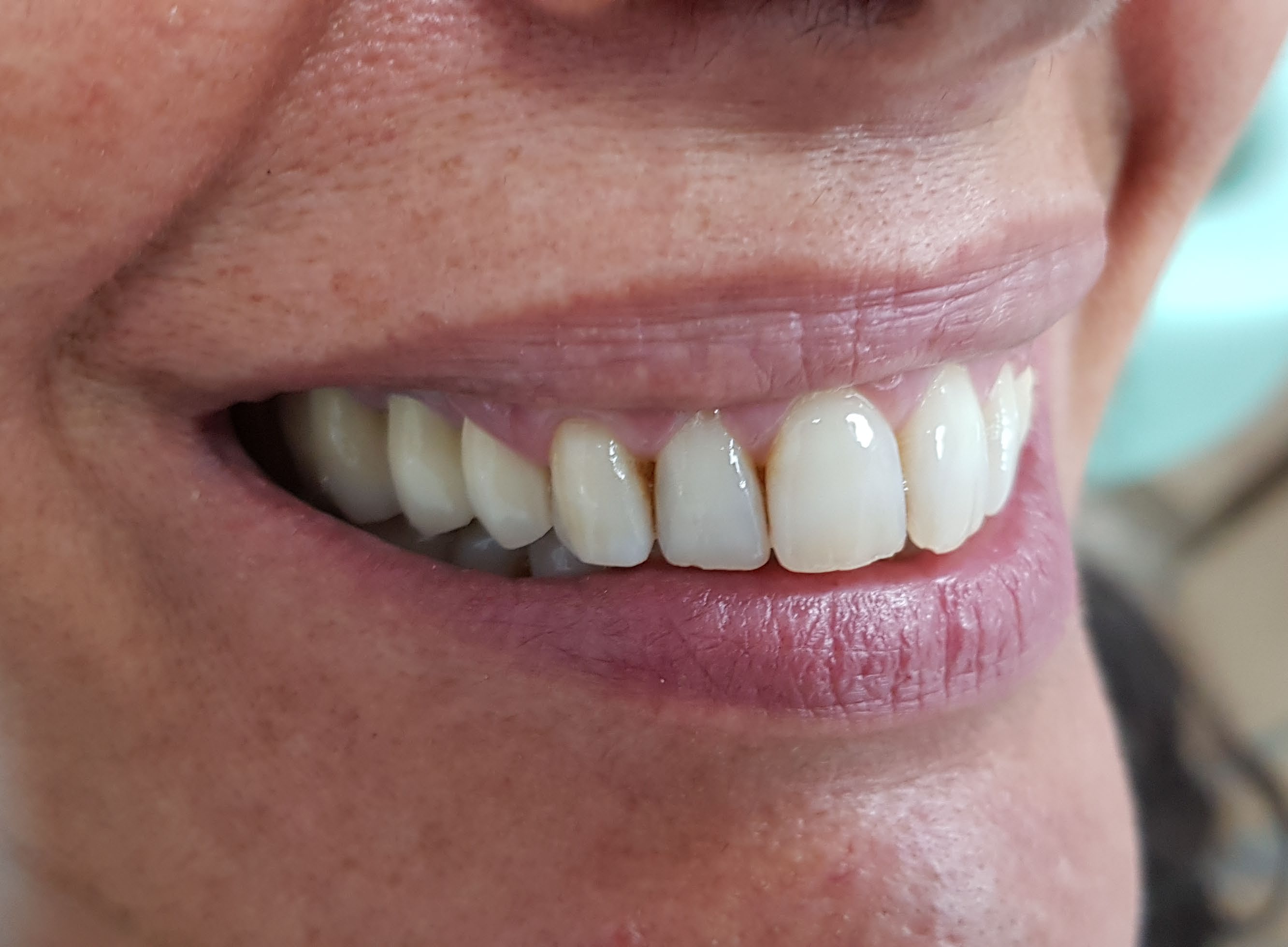 After aesthetic side-smile periodontal treatment showing improved tissue balance.