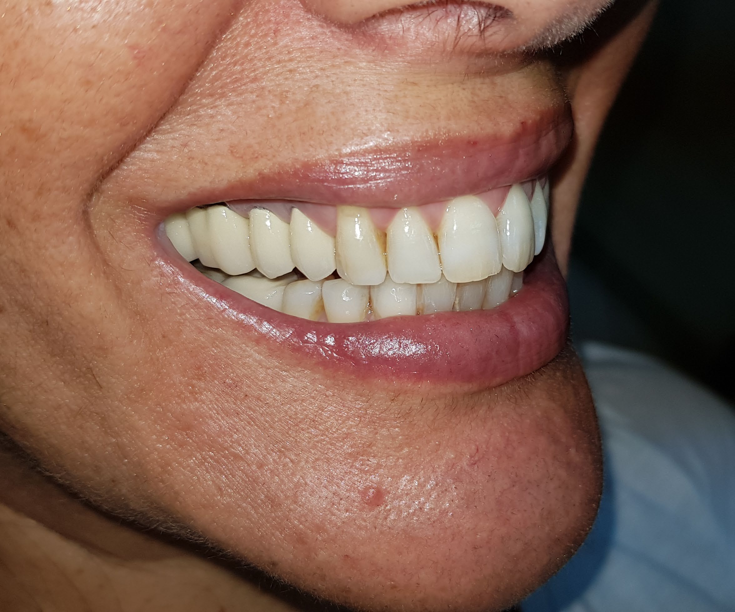 Before aesthetic side-smile periodontal treatment.