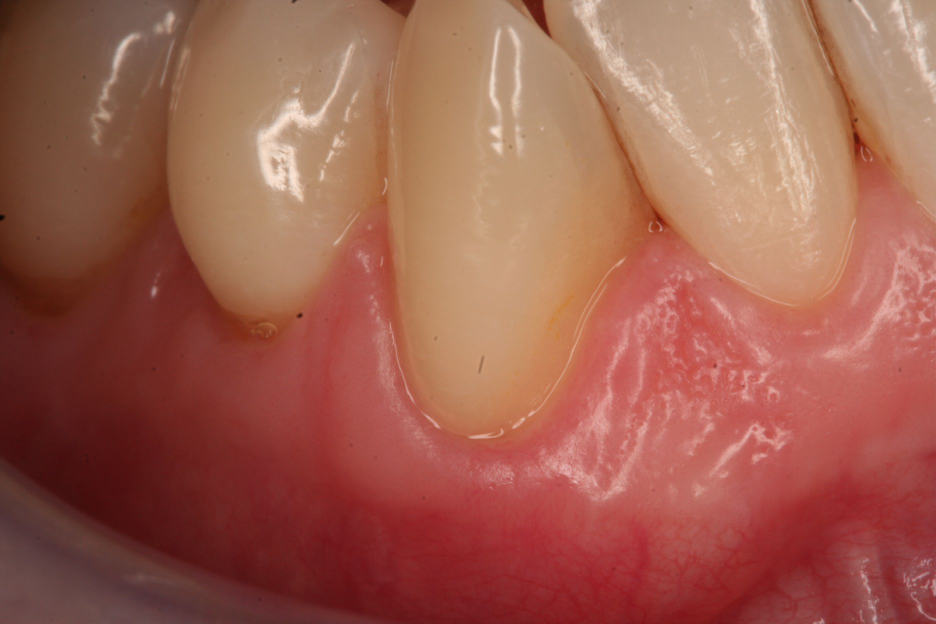 After canine root coverage showing improved gingival margin and tissue support.