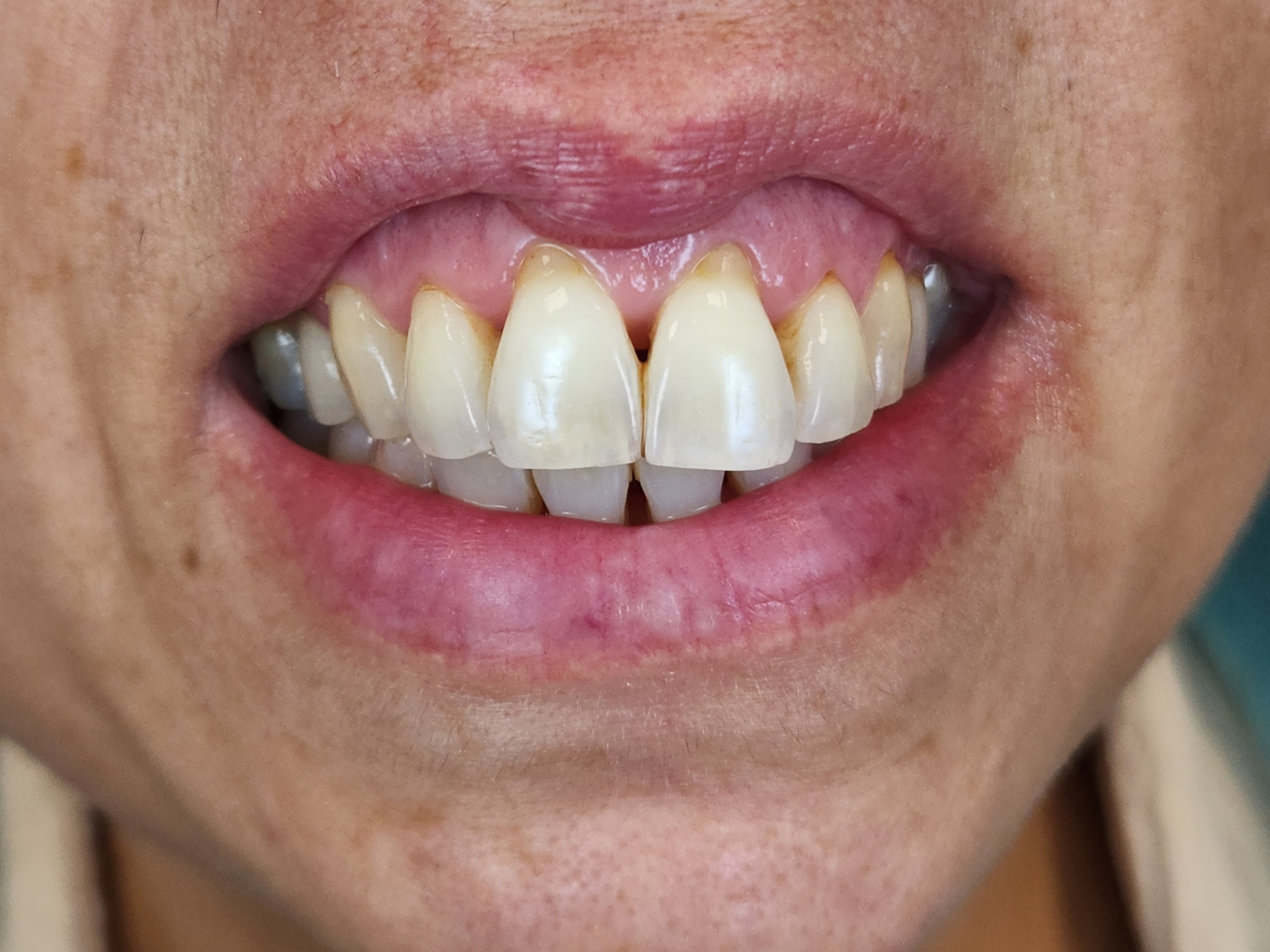 Before gum rejuvenation treatment for Miller Class III recession.