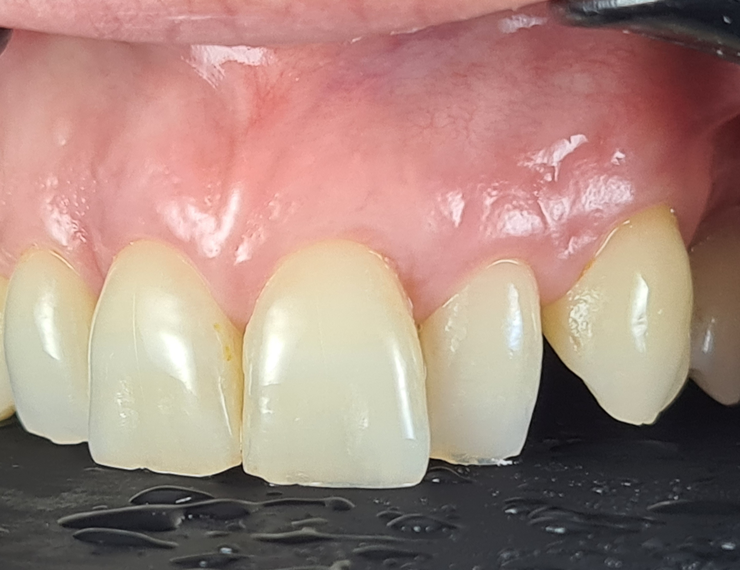 Before anterior gum rejuvenation treatment.