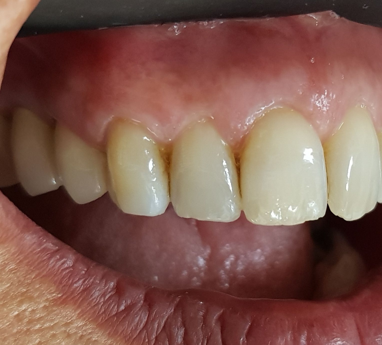 After lateral recession treatment showing improved soft-tissue coverage.