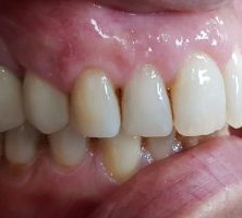 Before lateral recession treatment showing exposed root and uneven gingival margin.