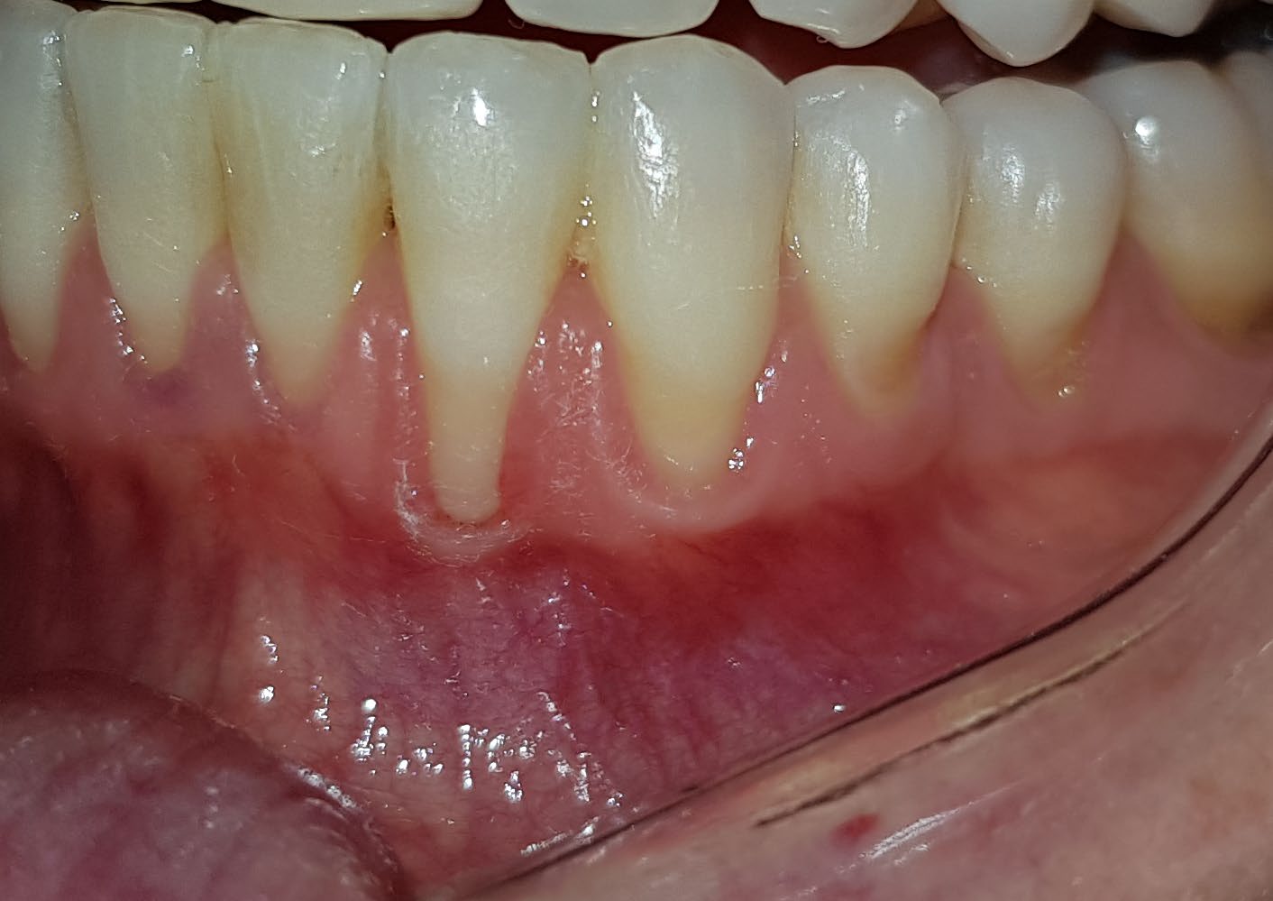 After mandibular recession treatment showing improved soft-tissue coverage.