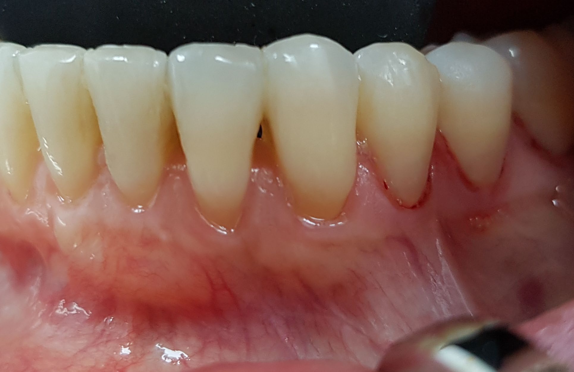 Before mandibular recession treatment showing lower anterior exposed root surfaces.