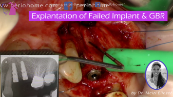 Explantation of Failed Implant & GBR