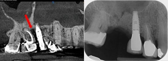 Extraction of Lost Tooth, While Saving Adjacent Implant