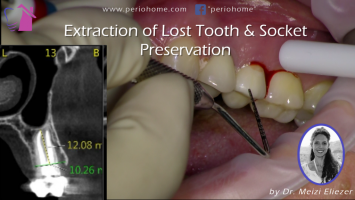 Extraction of Lost Tooth and Socket Preservation