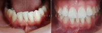 Frenectomy BEFTER