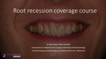 Root Recession Coverage Course